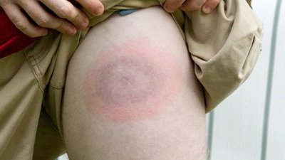 Можна сплутати з грипом: на Тернопільщині фіксують випадки небезпечної інфекції