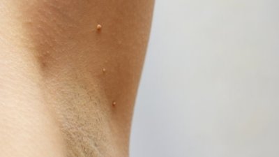 Дівчат-підлітків вакцинуватимуть від вірусу папіломи