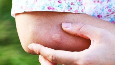 Величезного паразита витягли з-під шкіри жінки на заході України: жахливі наслідки укусу комара